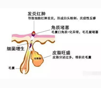 用了祛痘产品痘痘更严重图片