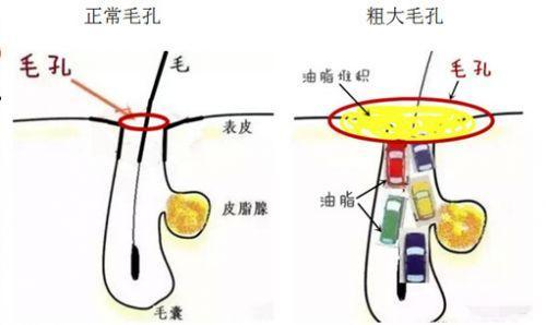 毛孔变大怎么改善图片