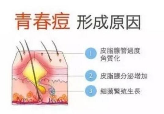 修复痘坑激光多少钱？一般怎么收费？