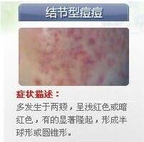 脸上长痘痘的图片库图片