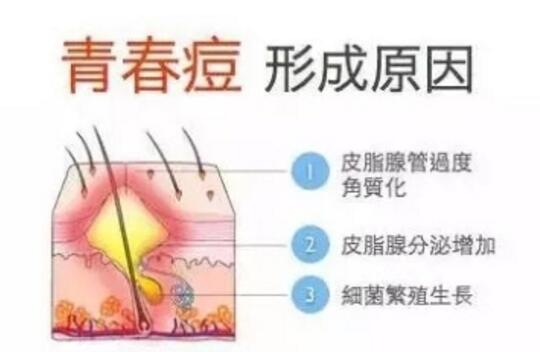 怎样洗脸消除痘痘反复是什么原因