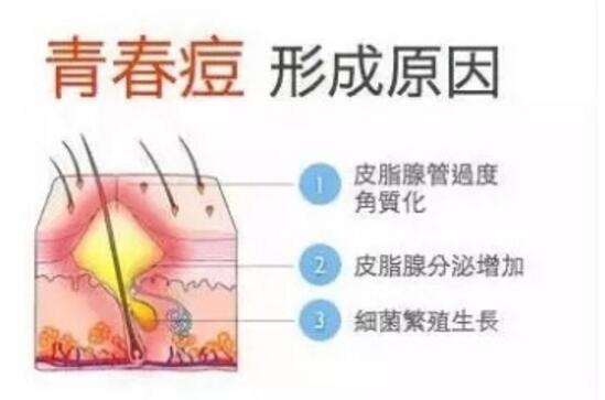 男生祛痘日常方法最有效祛痘印方法