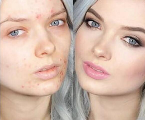 化妆容易产生痘痘禁区男生护肤方法