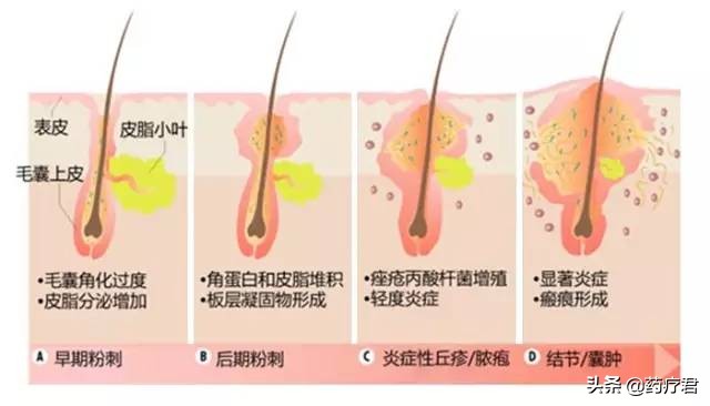 喝牛奶的危害竟然是长痘（为什么喝牛奶容易长痘）