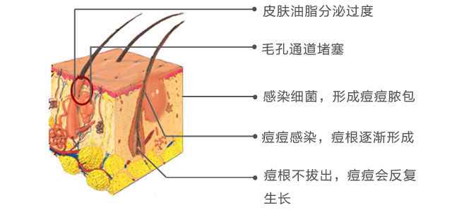 夏天到了,油性皮肤怎么祛痘