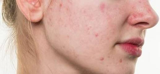 为什么痘痘要挤第二次才出来：脸上的痘印消不去 可能是你护肤有问题