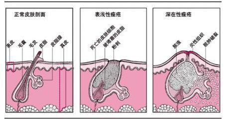 夏天到了,油性皮肤怎么祛痘