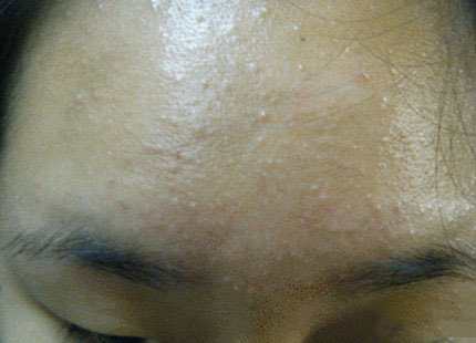 为什么用冻干的护肤品会长痘痘：脸上长痘痘粉刺怎么办 推荐白头粉刺的治疗方法