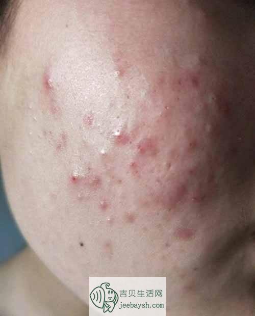 为什么脸上有三个痘痘不痛不痒：脸上长痘痘怎么办 睡前这样做远离痘痘肌肤问题